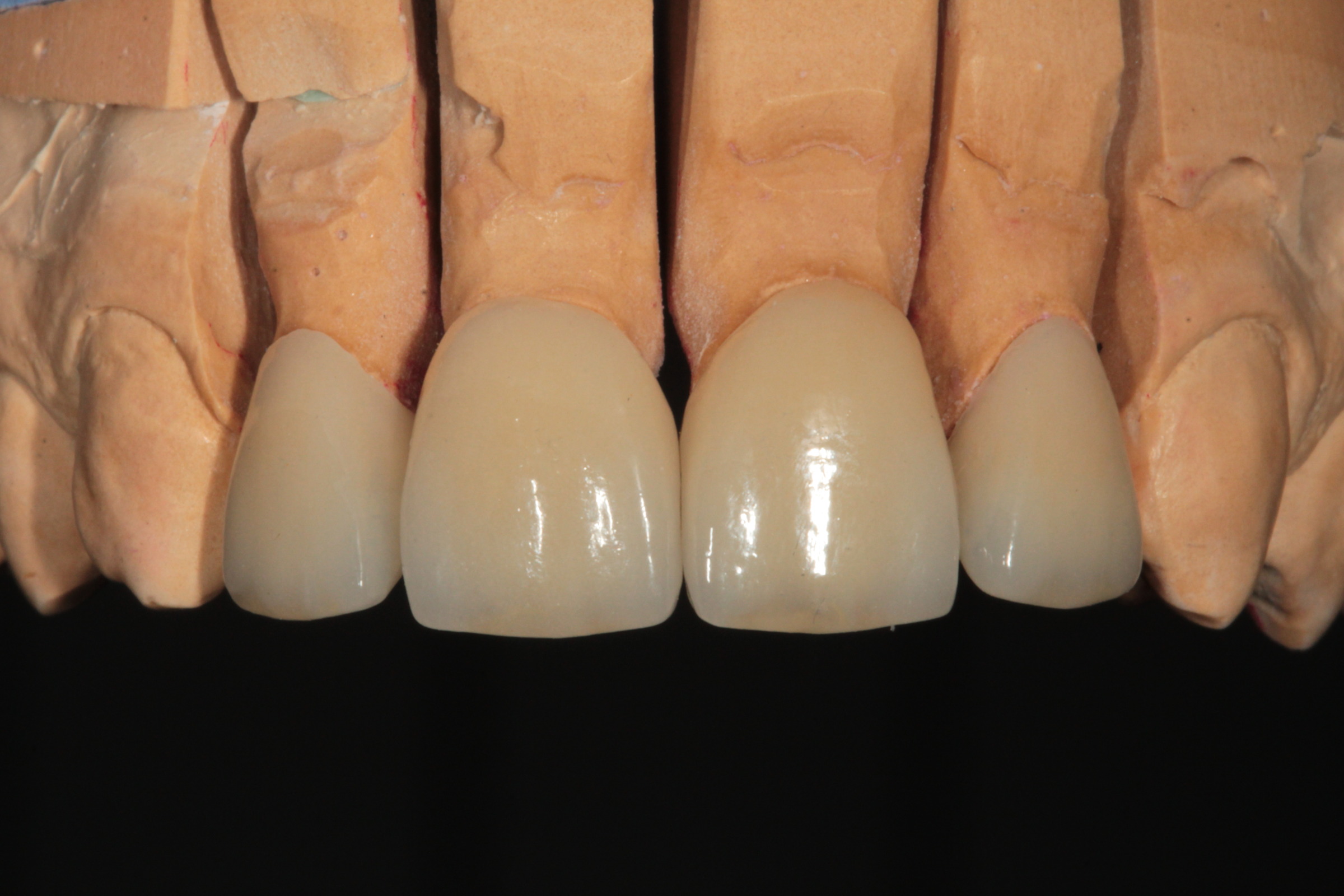 Большие резцы зубы. Формы фронтальных зубов. Коронки центральных резцов. Форма центрального резца.